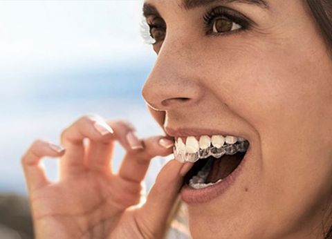 Aparelho Invisalign