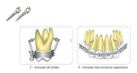 Orto implantes