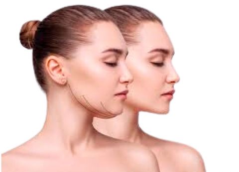 Lipoaspiração de papada