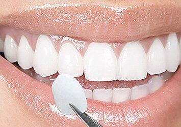 Facetas Estéticas ou Lentes de Contato